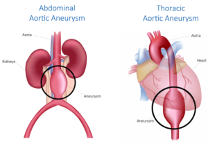 Abdominal-Aortic-Aneurysm
